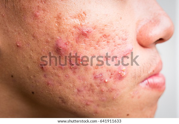 Close Hormonal Acne Man Face Right Stock Photo (Edit Now) 641911633