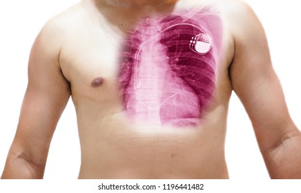 Close up Human chest x-ray with pacemaker in chest,soft and blurry when views full resolution. Isolated background .