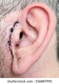 Close Up Of Human Ear With Dried Blood Over Suture Stitches After Having Plastic Surgery. 