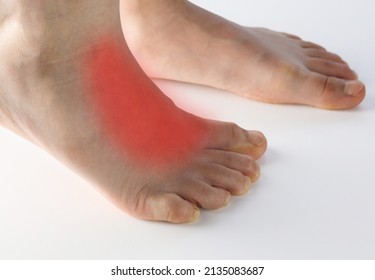 Close Up Human Foot With Red Area To Point Of Pain On Top Of Foot On Extensor Tendonitis Caused By Tight Shoe, Flat Feet, Prolong Standing , Muscle Tightness In Children Isolated On White Background.