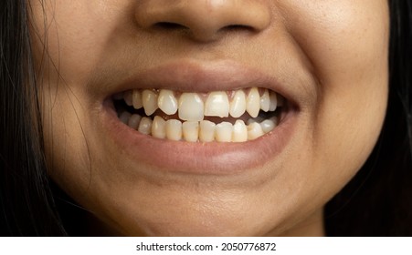 Close Up Of Human Teeth And Partially Broken Tooth