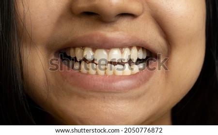Close up of human teeth and partially broken tooth