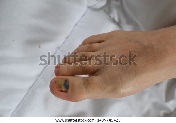 Close Hurt Purple Nail Big Toe Stock Photo Edit Now 1499745425