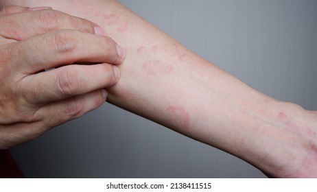 Close up image of arm suffering severe urticaria or hives or kaligata. scratching itchy hands. Allergy symptoms.
