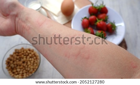 Close up image of arm suffering severe urticaria or hives or kaligata with illustration of allergy trigger foods.  Eggs, milk, beans, strawberry, and chesse.