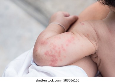 Close Up Image Of Baby Skin Texture Suffering Severe Urticaria, Nettle Rash.