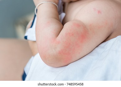 Close Up Image Of Baby Skin Texture Suffering Severe Urticaria, Nettle Rash.