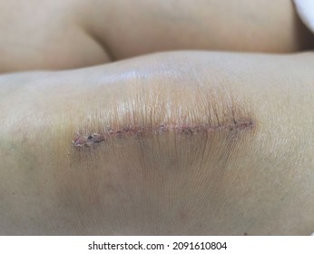 Close Up Image Of Knee After Two Weeks  After Knee Reconstruction Surgery.