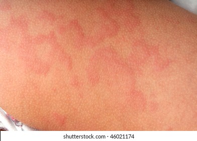 mumps rash