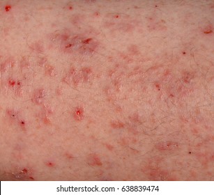 Close Up Image Of A Patch Of Human Skin With A Severe Rash Breakout Infection.