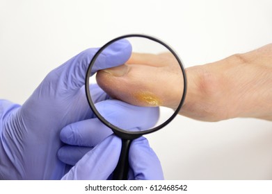 Close Up image of podologist checking with magnifying glasses the callus.Horizontal studio picture on white background.