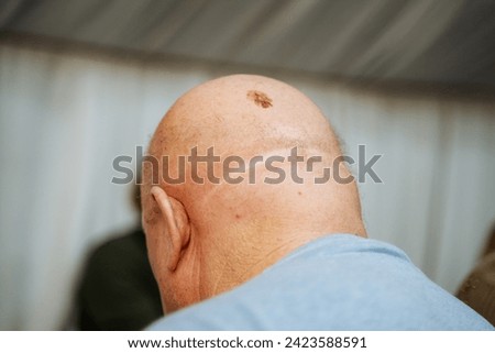 A close up image showing the back of a mans head with a shaved crown and a visible scar, possibly from a surgical procedure or injury. The scar is prominently displayed on the skin.