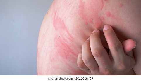 Urticaria Images Stock Photos Vectors Shutterstock