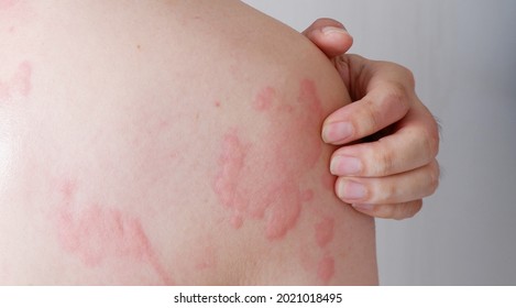 Close up image of skin texture suffering severe urticaria or hives or kaligata. Allergy symptoms. - Shutterstock ID 2021018495