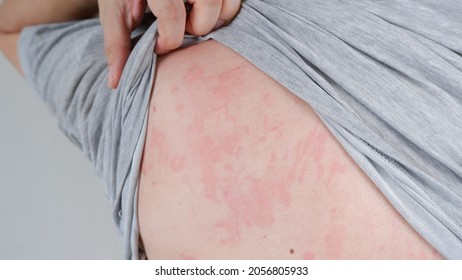 Close up image of skin texture suffering severe urticaria or hives or kaligata on the back. Allergy symptoms.