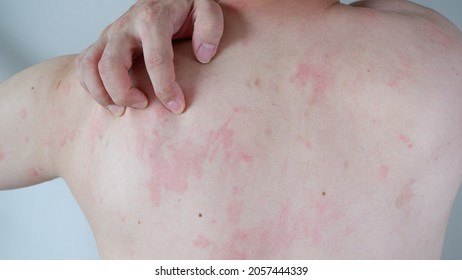 Close Up Image Of Skin Texture Suffering Severe Urticaria Or Hives Or Kaligata On The Back. Allergy Symptoms.