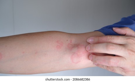 Close Up Image Of Skin Texture Suffering Severe Urticaria Or Hives Or Kaligata On Arm. Allergy Symptoms.