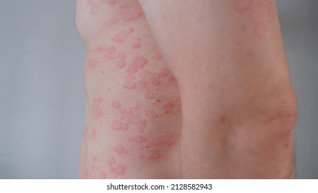 Close up image of skin texture suffering severe urticaria or hives or kaligata. Allergy symptoms. - Shutterstock ID 2128582943