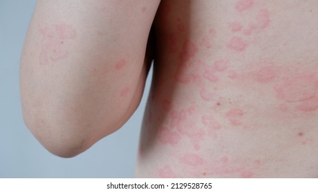 Close up image of skin texture suffering severe urticaria or hives or kaligata on back and arm. Allergy symptoms.