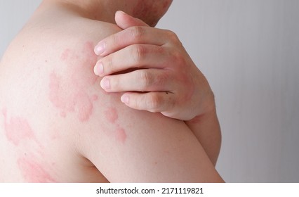 Close up image of skin texture suffering severe urticaria or hives or kaligata. Allergy symptoms. - Shutterstock ID 2171119821