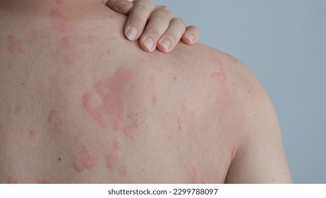 Close up image of skin texture suffering severe urticaria or hives or kaligata on back. Allergy symptoms. - Shutterstock ID 2299788097