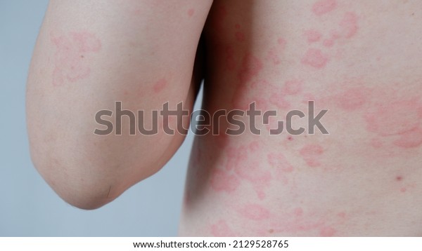 Close up\
image of skin texture suffering severe urticaria or hives or\
kaligata on back and arm. Allergy\
symptoms.