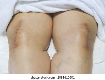 Close Up Image Of Two Knees, Two Weeks  After Knee Reconstruction Surgery.