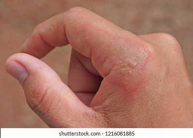 Impetigo Images Stock Photos Vectors Shutterstock