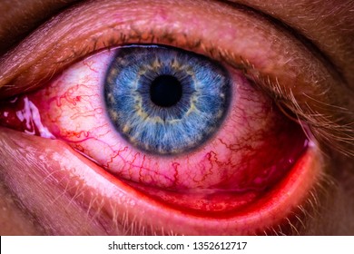 Close up of infected, sick eye with red bloodshot veins, insomnia 