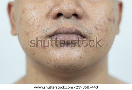 Close up of Inflamed acne problem on Asian man face, swelling, redness, and pores badly blocked by bacteria, oil, and dead skin cells.