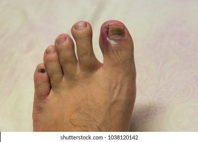 Close Up Of Ingrown Toenail Problem. 