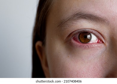 Close Up Irritated Infected Red Bloodshot Woman Eye. Hemorrhage In The Sclera Or Mucous Membrane Of The Eye