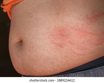 Close Up Itchy Body Rash Caused By Allergies On Middle Part Of Man Body. Scratch Marks On The Skin.