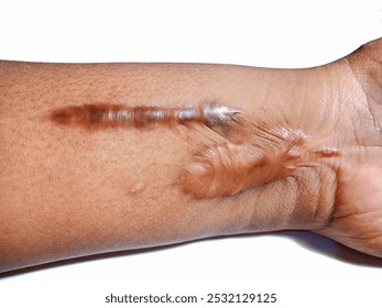 Close Up of Keloid Scar (Hypertrophic Scar) on Human Arm skin after Accident.