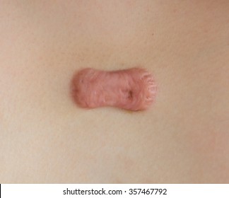 Close Up Keloid Scar On Skin