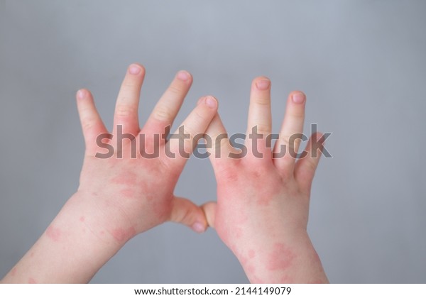 close up kids hand with allergic\
rash or eczema. severe allergic reaction, atopic\
skin