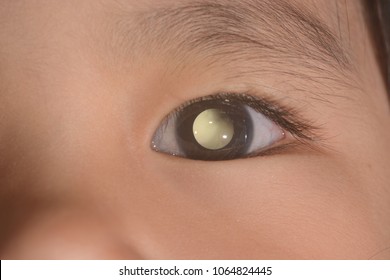 close up of the leukocoria during eye examination.