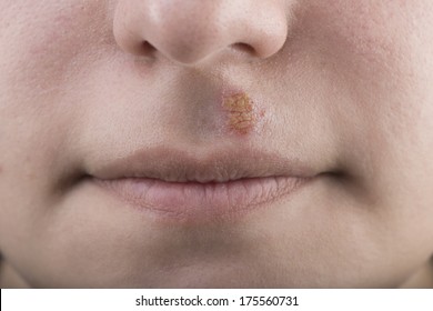 Herpes Simplex Labialis High Res Stock Images Shutterstock