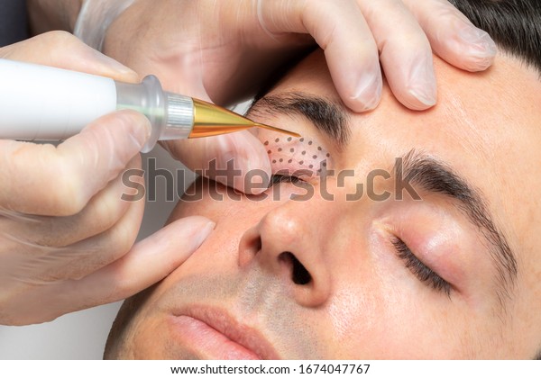 Close up macro detail of\
middle aged man having skin tightening on eyelids with laser plasma\
pen.