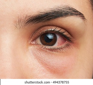 Close Up Macro Of One Woman Eye With Infection