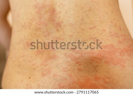 A close macro perspective captures a human lower back experiencing a widespread cutaneous reaction. Soft lighting emphasizes the inflamed epidermis, revealing raised wheals and severe redness. Symbolizing physiological distress, this authentic clinical visual is ideal for dermatology education and medical publishing.