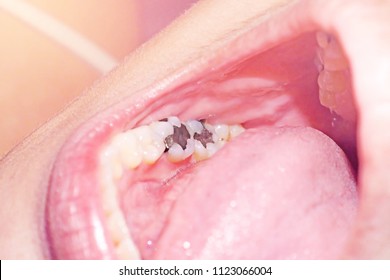 Close Up Macro Photo Of Metall Amalgam Dental Fillings