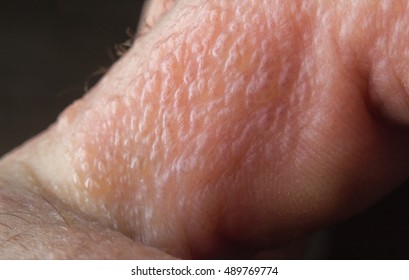 Close Up Macro Poison Ivy Rash Blisters On Human Skin