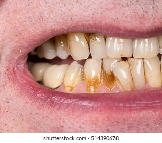 impotencia de la placa dental