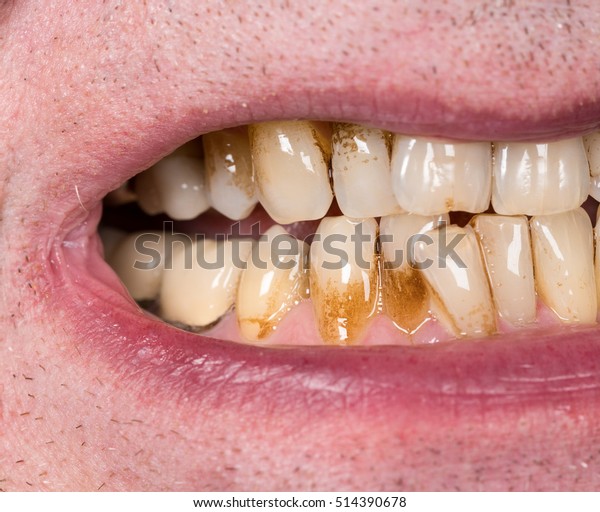 light brown spots on teeth near gums