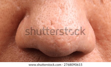 Close up macro view of a human nose showing skin problems. Enlarged pores and whiteheads