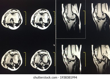 Close Up Magnetic Resonance Imaging Lower Extermity (MRI Knee),Medical Healthcare Concept.