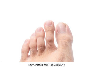 Close Up Of Male Foot And Dirty Long Toe Nail Isolated On White Background With Clipping Path. Medical Foot And Cleanliness Concept.