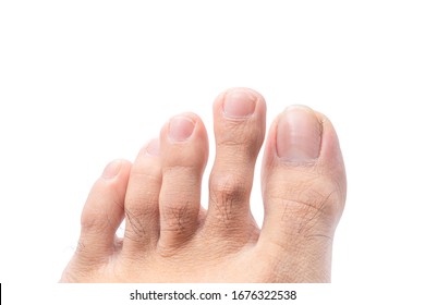 Close Up Of Male Foot And Dirty Long Toe Nail Isolated On White Background With Clipping Path. Medical Foot And Cleanliness Concept.