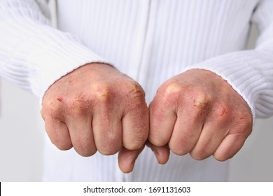 Close Up Of Male Hands With Dry Skin Damage. Dermatology Concept Human Hands With Skin With Cracks And Wounds. Human Hands Close Up